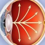 glaucoma 150x150 Glaucoma.Tratamiento, clasificación y video