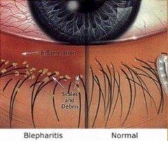 Toallitas de higiene ocular, Conjuntivitis - Blefaritis - Limpieza de ojos