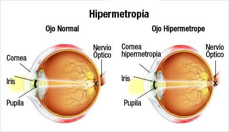 ojo con hipermetropia