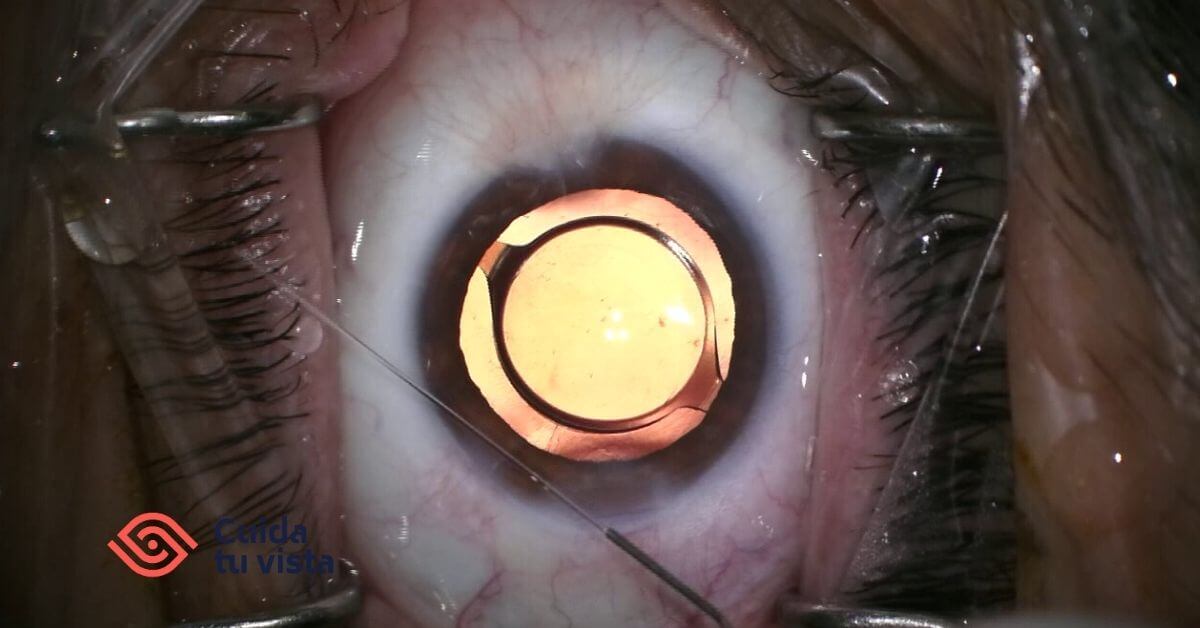 lente intraocular en una operación de cataratas